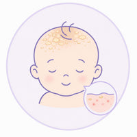 Dermatit Seborrheik